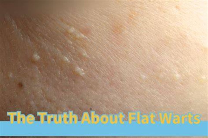 Are Flat Warts an STD