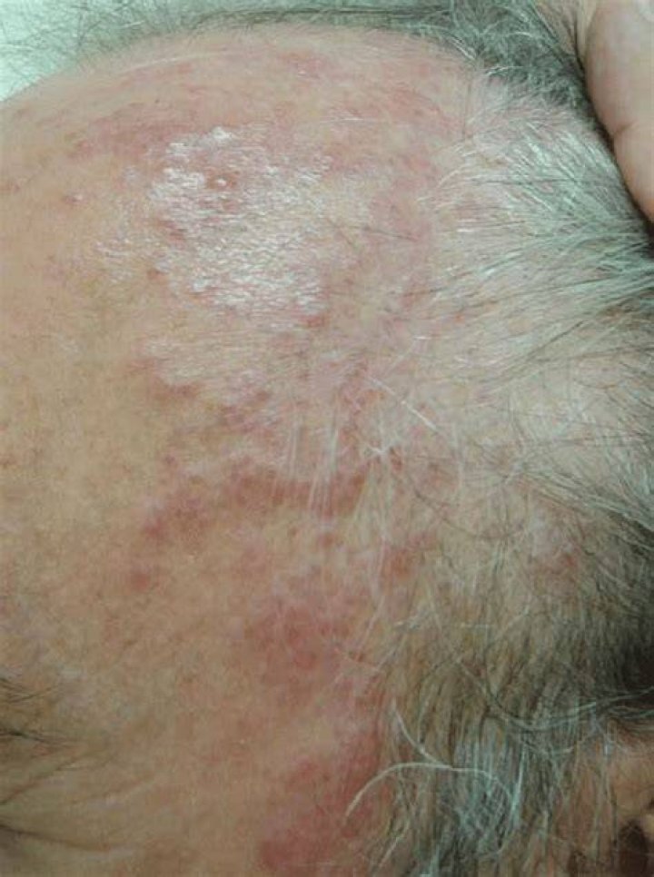 Are Macules dangerous