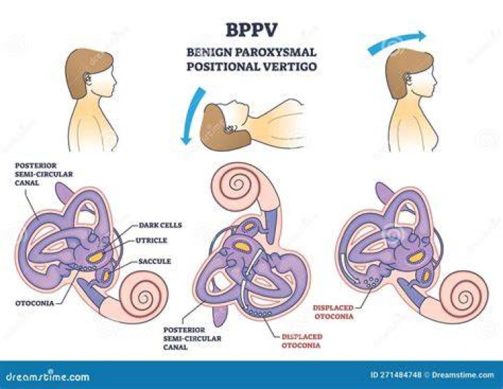 Can doctors see BPPV