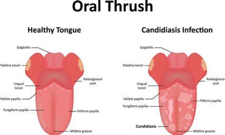 Can Thrush be an STD