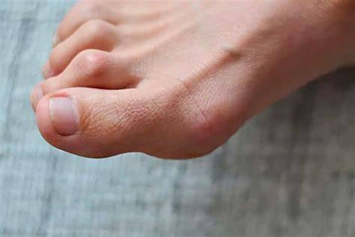 Can toes be realigned
