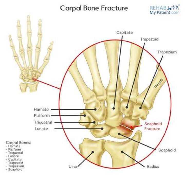 Can you break Carpals