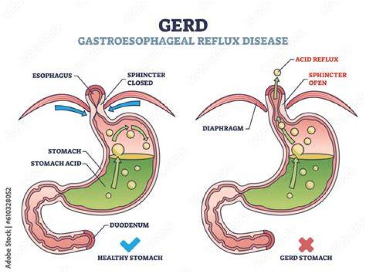 Do pickles cause GERD