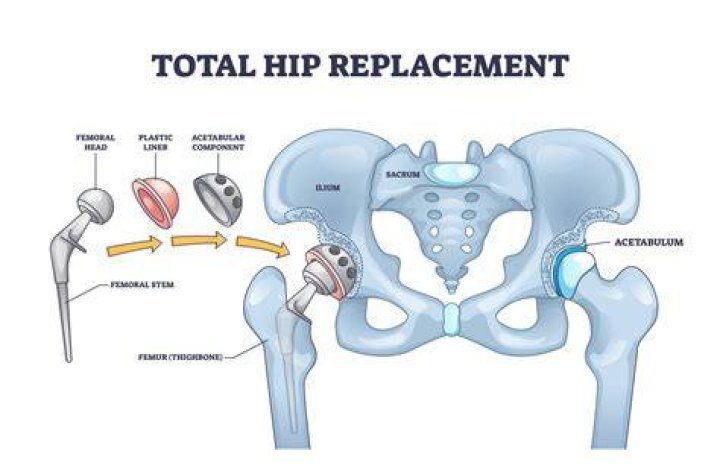 How do they pin a hip
