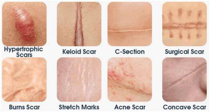 How do you get scars