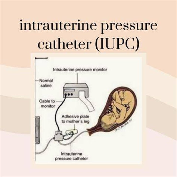 How does an IUPC work