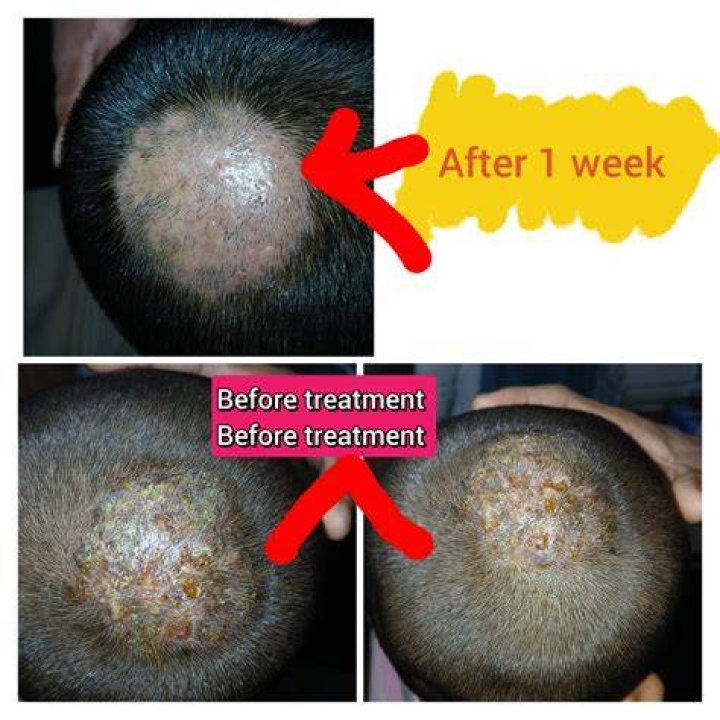 How is kerion treated