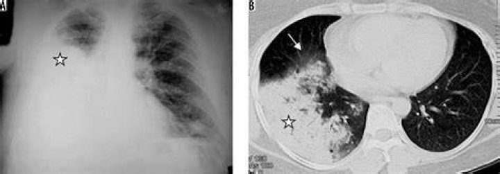 How is PNA diagnosed