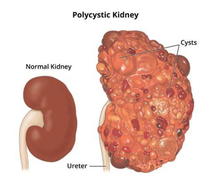 How serious is ADPKD