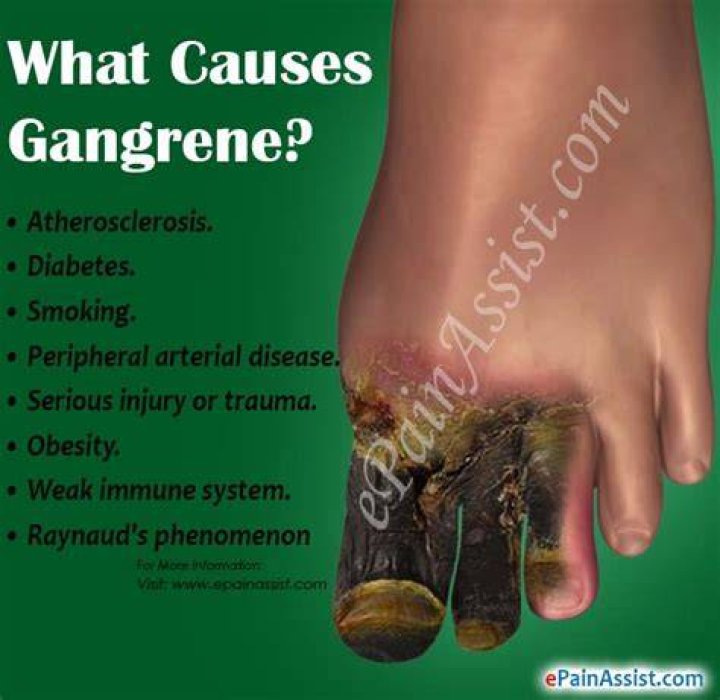 Is a gangrene painful