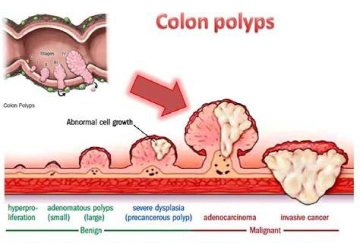 Is a polyp a neoplasm