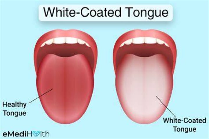 Is a white tongue bad