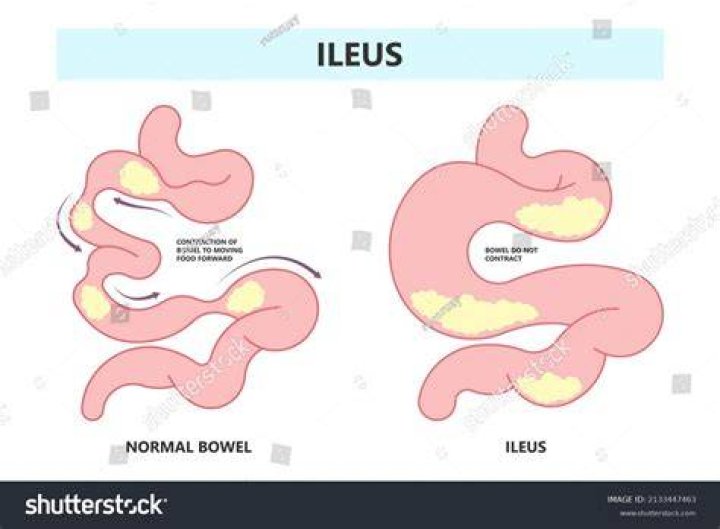 Is an ileus dangerous