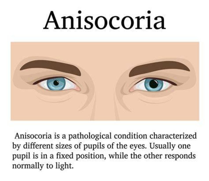 Is Anisocoria genetic