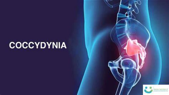Is Coccydynia serious