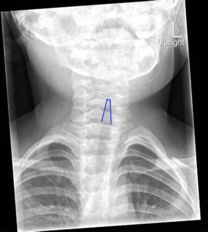 Is croup a subglottic