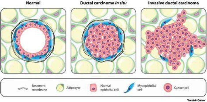 Is DCIS cancer or not