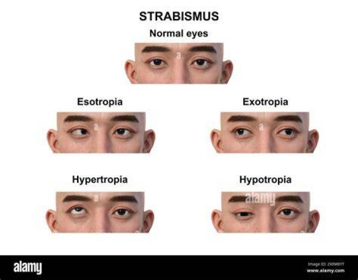 Is esotropia serious