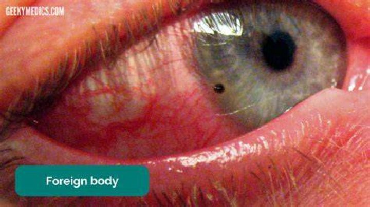 Is eye a foreign body