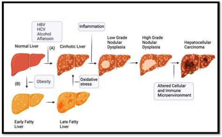 Is hepatoma a disease