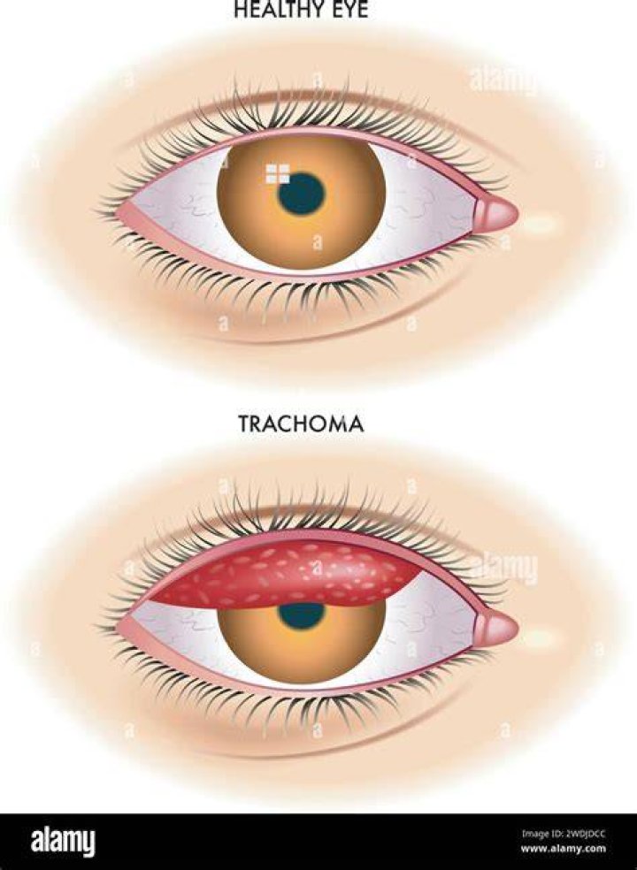Is trachoma pink eye