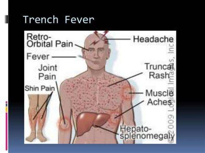 Is trench fever fatal