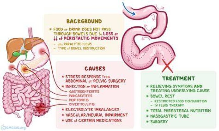 What causes an ileus