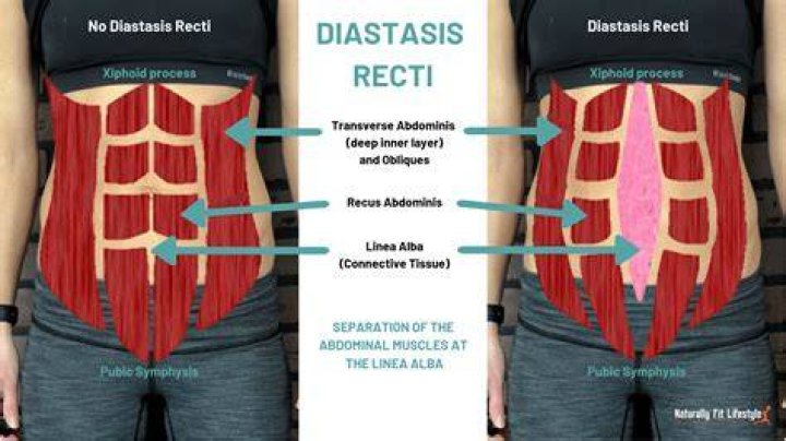 What causes Diastasis
