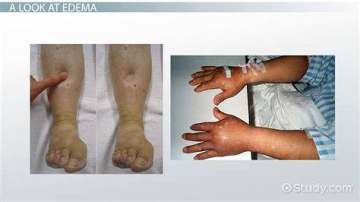 What causes edematous