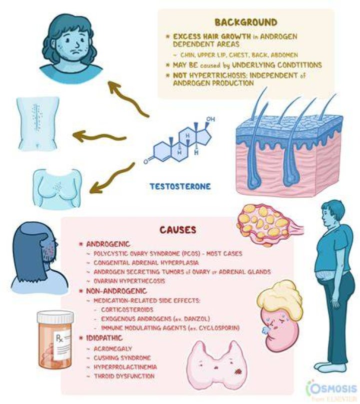 What causes hirsutism