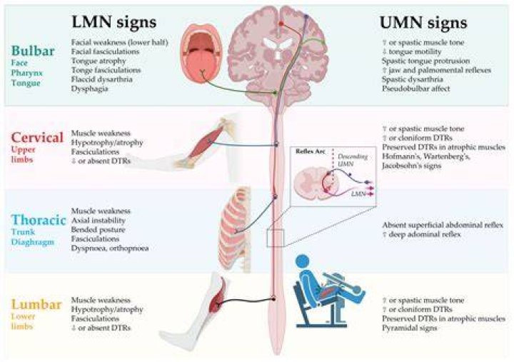 What causes LMN signs