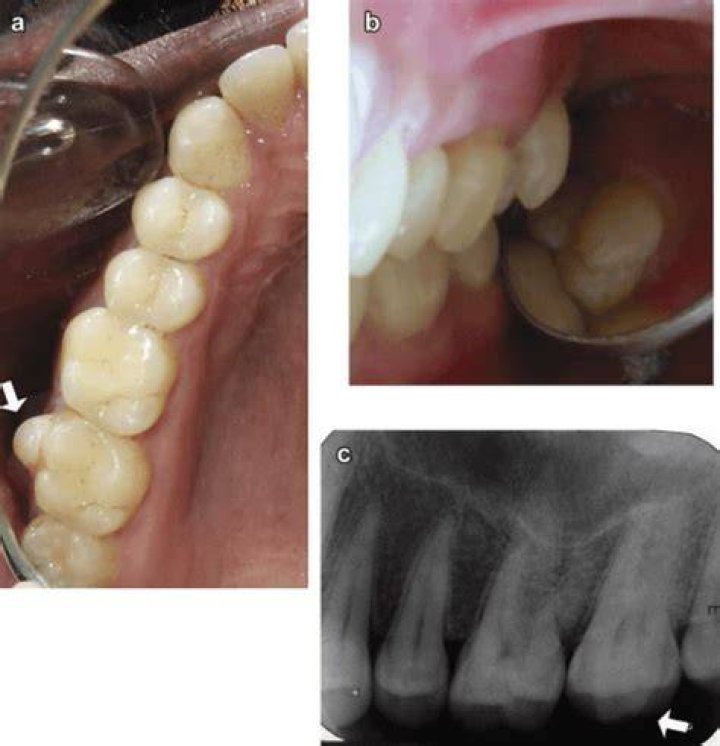 What causes Paramolar