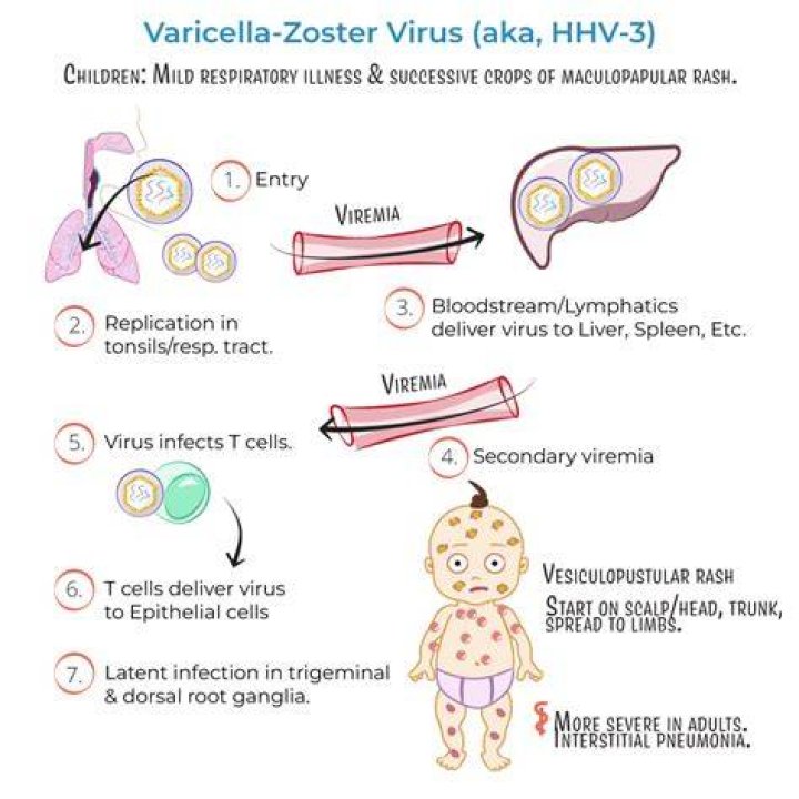 What causes varicella