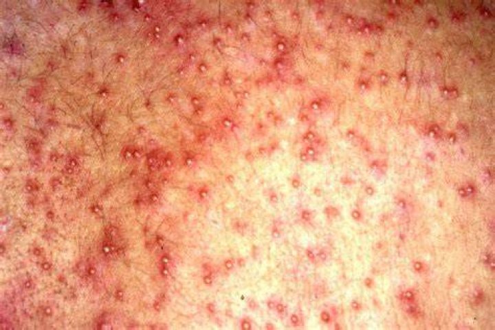 What does a rash look