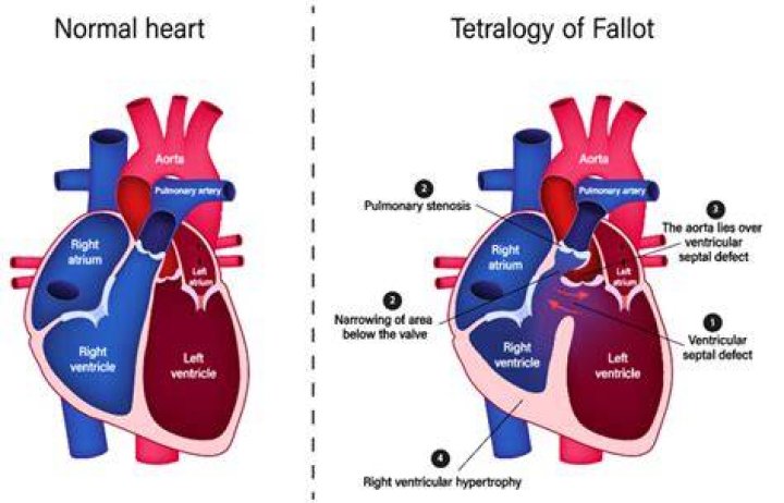What does Fallot mean