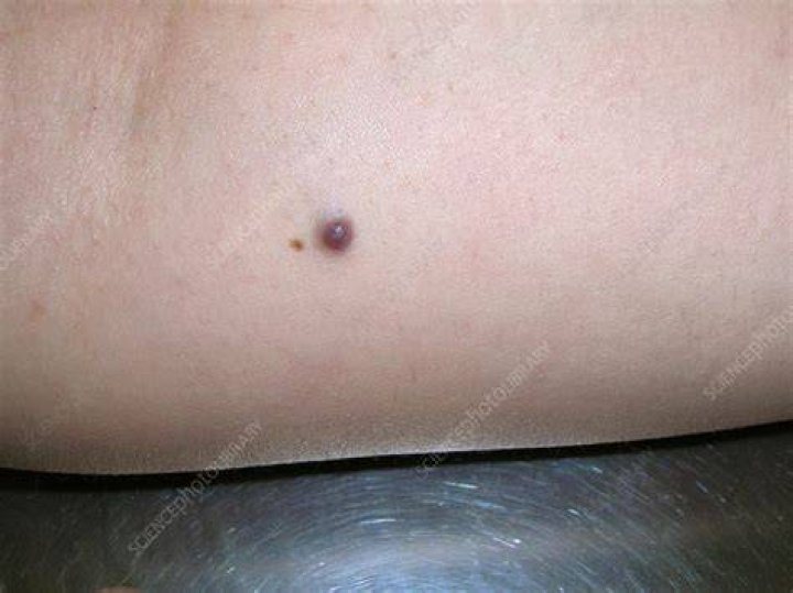 What is a Glomangioma