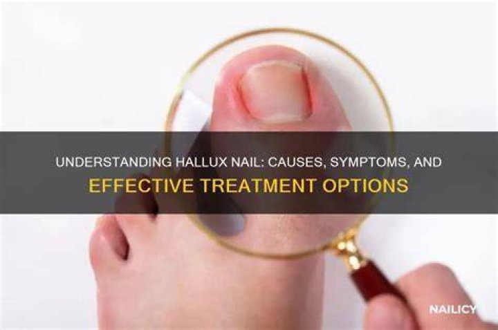 What is a hallux nail