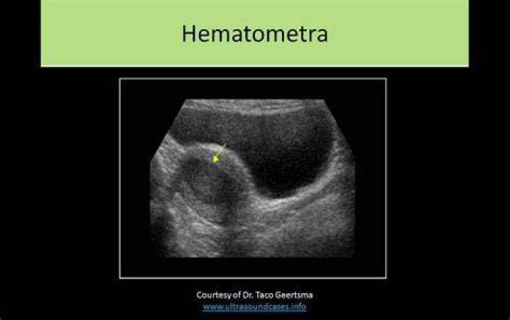 What is a Hematometra