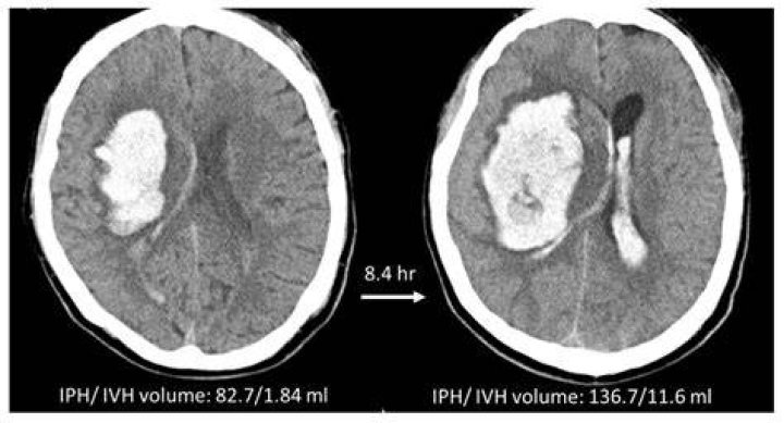 What is a IPH medical