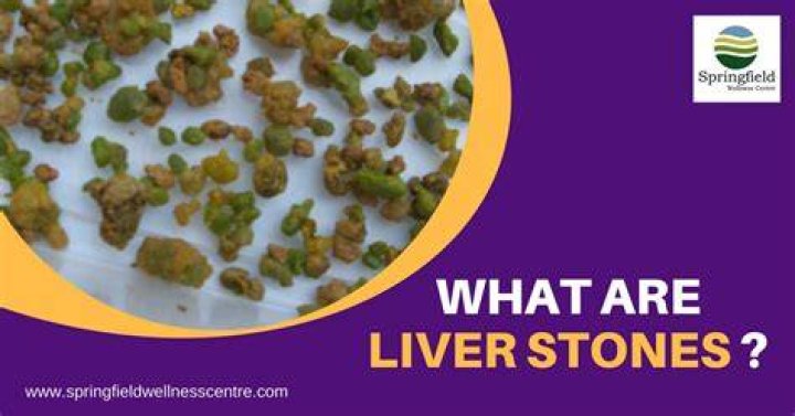What is a liver stone