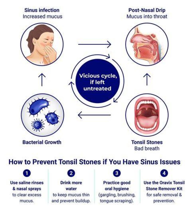 What is a sinus stone