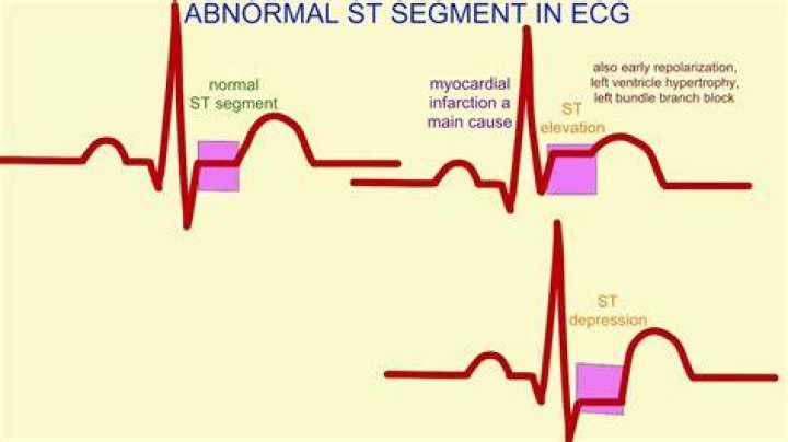 What is abnormal ECG