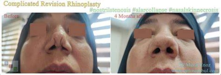 What is Alar collapse