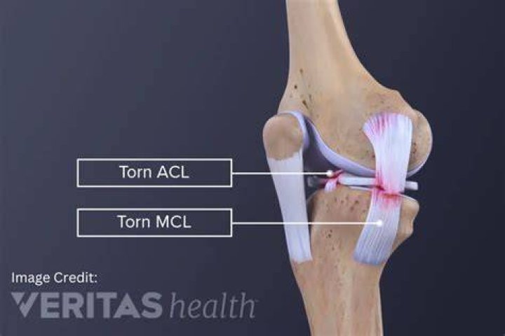 What is an ACL or MCL