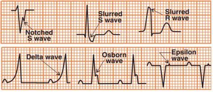 What is an S wave ECG
