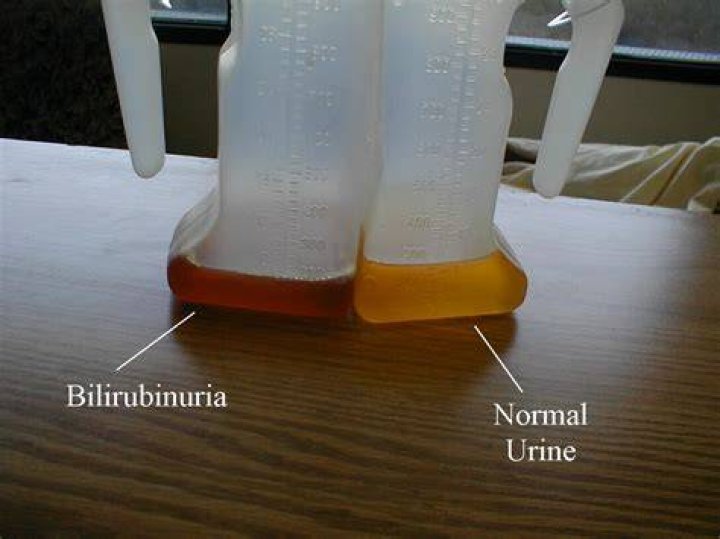 What is Bilirubinuria