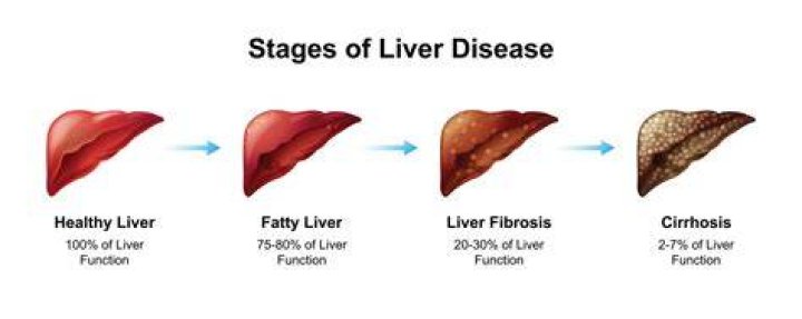 What is cause of CLD
