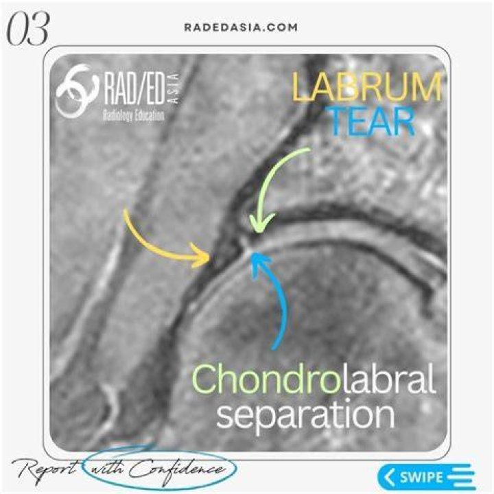 What is Chondrolabral