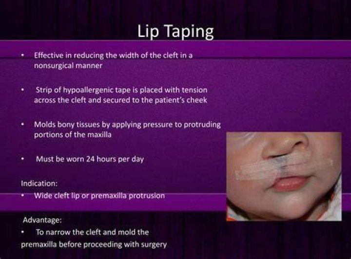 What is cleft taping