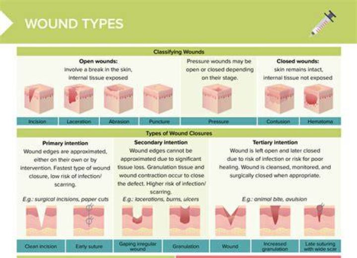 What is closed wound